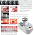 Extrahiertes Zahnmaterial als autologes KEM - das Smart Grinder-Verfahren