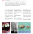 „Sofortimplantation“ mit autologem
KEM aus extrahierten Zähnen